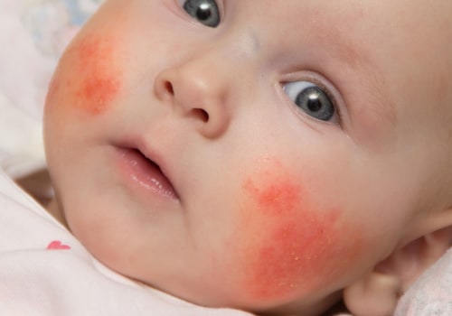 Allergies in Children: Understand the Risks and Treatments for Your Kids
